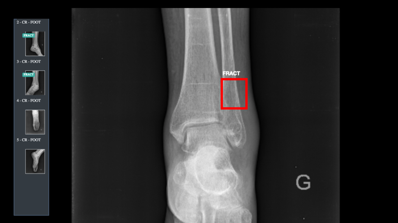 Détection de fracture